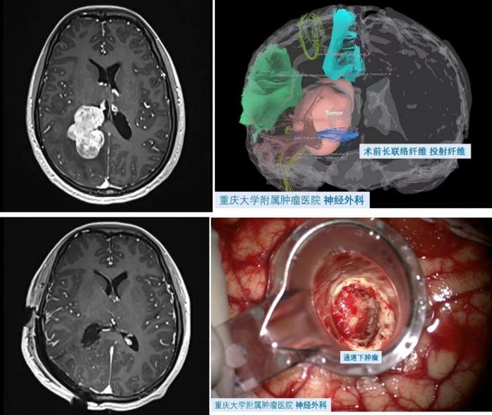 【萊沃醫(yī)療：病例分享】重慶大學附屬腫瘤醫(yī)院神經(jīng)外科Endoport下切除三角區(qū)巨大腦膜瘤